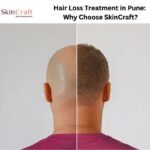 Hair Loss Treatment in Pune: Why Choose SkinCraft?