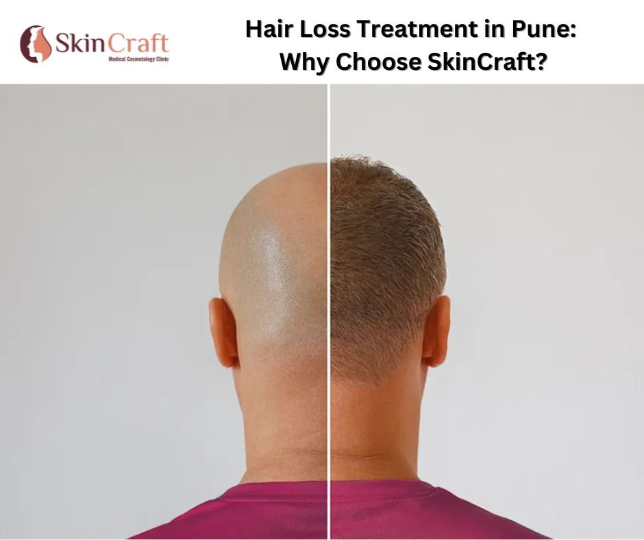 Hair Loss Treatment in Pune: Why Choose SkinCraft?