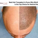 Best Hair Transplant in Pune: Why SkinCraft is the Top Choice for Natural Results