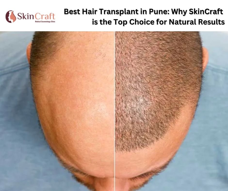 Best Hair Transplant in Pune: Why SkinCraft is the Top Choice for Natural Results