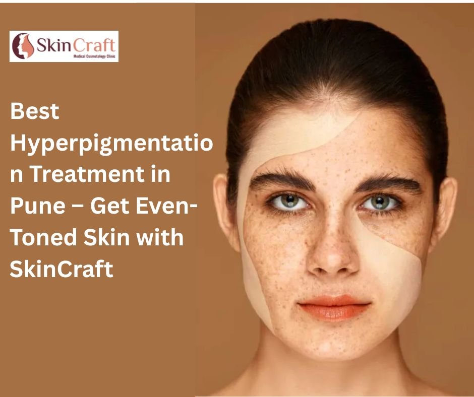 Best Hyperpigmentation Treatment in Pune – Get Even-Toned Skin with SkinCraft