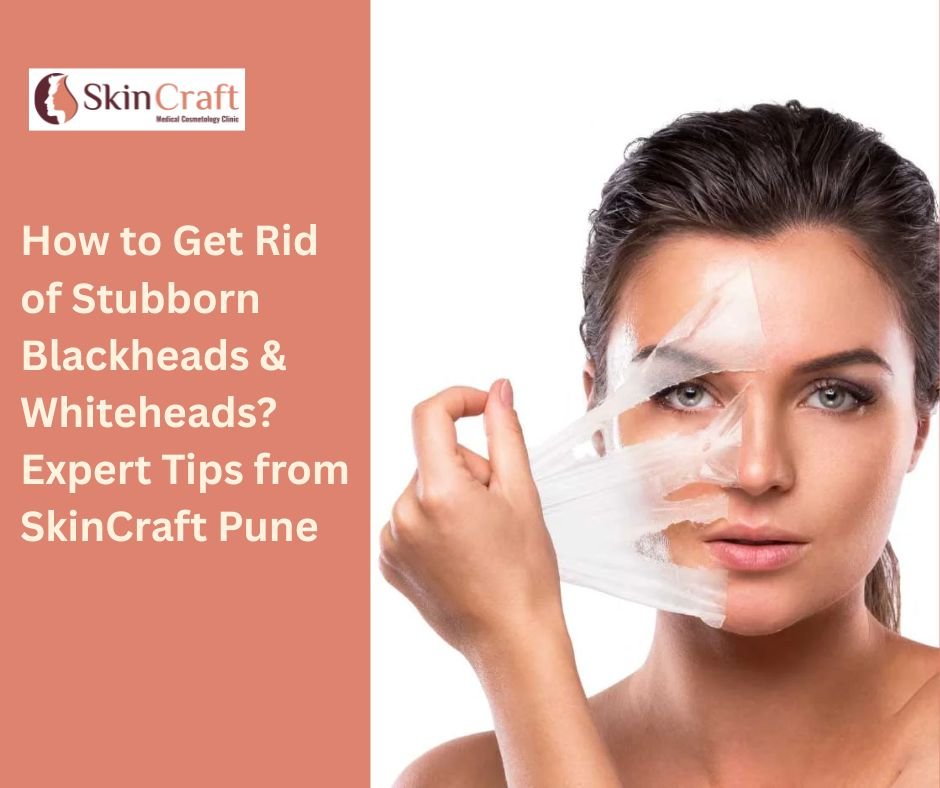 How to Get Rid of Stubborn Blackheads & Whiteheads? Expert Tips from SkinCraft Pune