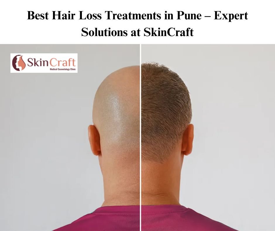 Best Hair Loss Treatments in Pune – Expert Solutions at SkinCraft