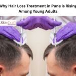 Why Hair Loss Treatment in Pune is Rising Among Young Adults